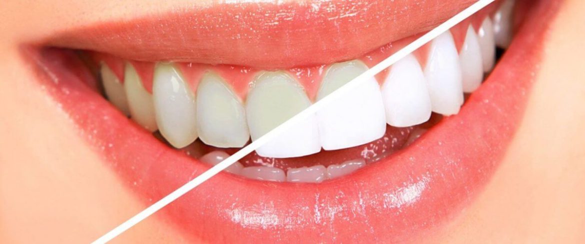 Template: Comments Disabled teeth whitening hd nx1c9o3z6wtjzdg24ckf4mac31hcqxhgmontc29zt4 1170x488 - Template: Comments Disabled